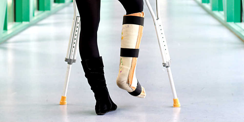 Frauenbeine mit Krücken, gebrochenes Bein im Gips